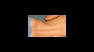 Как лечить укусы клопов?