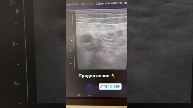 Тромбоз вен на ноге. Как лечить тромбы? Лечение тромбоза. Флеболог. Флеболог Москва смотреть онлайн