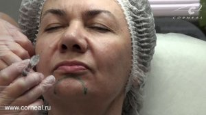 Корректируем губо подбородочную складку