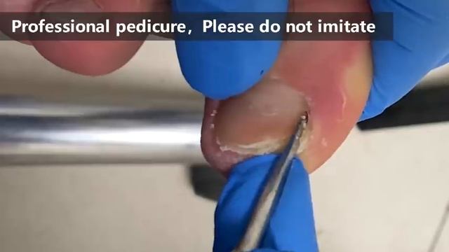 Pedicure tutorial ：Trimming of extra thick toenails【Xue Yidao】 смотреть онлайн