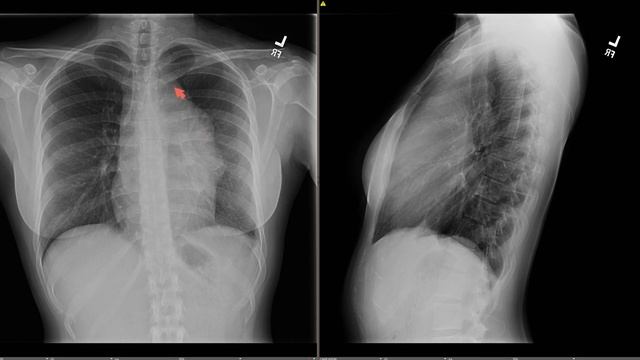 Classic Case: Hodgkin's Lymphoma смотреть онлайн