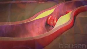 Что такое  инфаркт миокарда