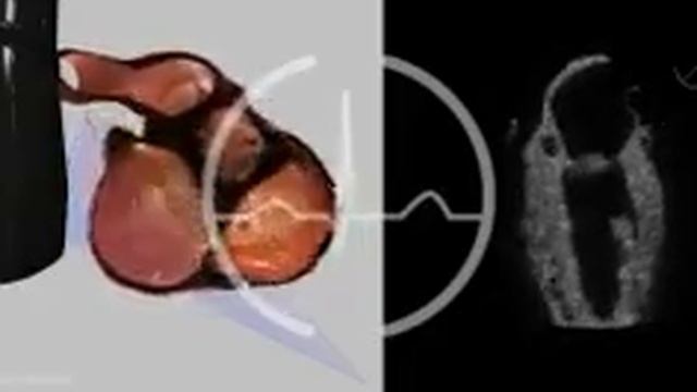 Комиссуральноя проекция митрального клапана смотреть онлайн