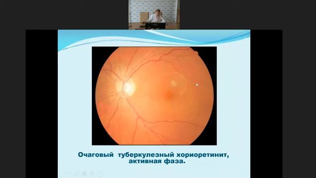 Туберкулез органа зрения смотреть онлайн