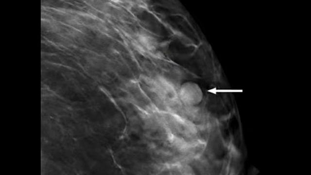 BIRADS Score| BIRADS Categories & Interpretation | Breast Screening/Imaging for Cancer | Breast Car смотреть онлайн