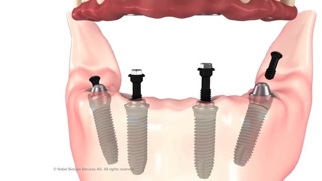 All-on-4 procedure animation. смотреть онлайн