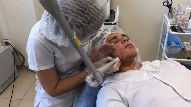 Лазерная шлифовка рубцов