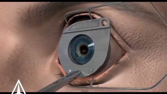 LASIK eye surgery - 3D animation смотреть онлайн