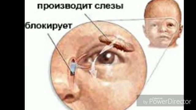 Наш опыт зондирования слёзного канала 2018 год Алматы КазНИИ Глазных болезней смотреть онлайн