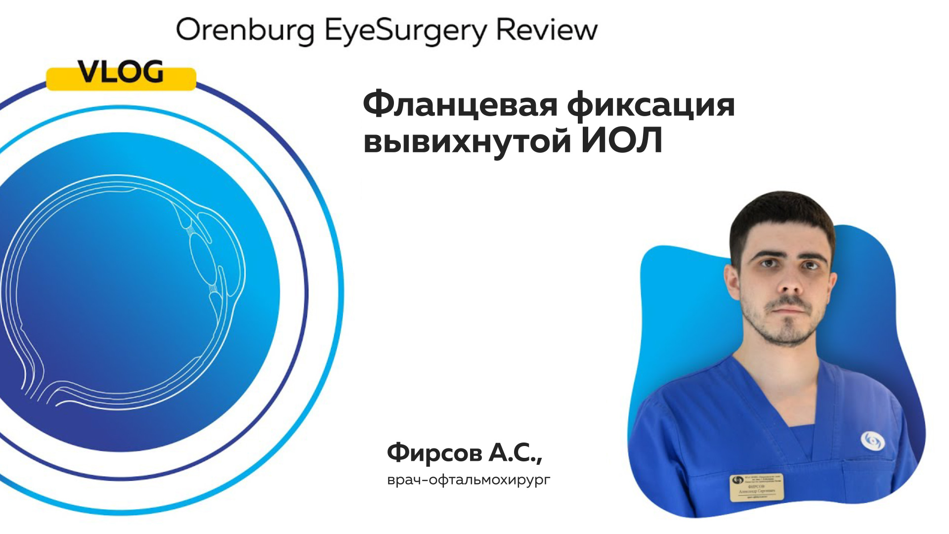 Фланцевая фиксация вывихнутой ИОЛ