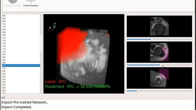 3D CNN Class Activation Map Rotator Cuff - Humerus Condyle Centered Volume смотреть онлайн