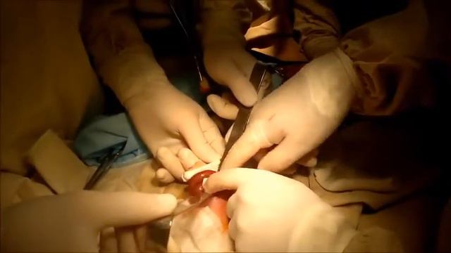 Гастрошизис