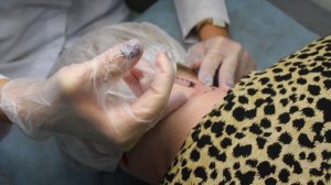 Удаление родинки электрокоагуляцией