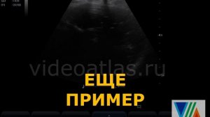 Кальцификаты (кальцинаты) селезенки.