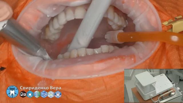 Professional oral hygiene -case 017 Acteon DTE Dentsply Coxo Floweis 3M KerrHawe (FHD multistream) смотреть онлайн