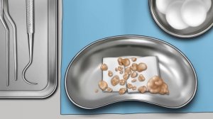 ASMR 오랫동안 없어지지 않는 입냄새 퇴치! 편도결석 치료 & 치석 제거 애니메이션 | 백태 제거 | Tartar & Tonsil Stone Removal Animation