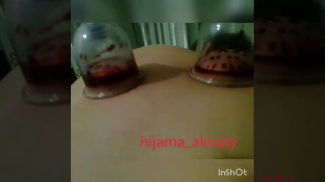 Чёрная кровь при хиджаме смотреть онлайн