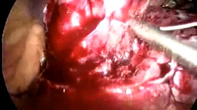 Резекция почки T1bN0M0 смотреть онлайн