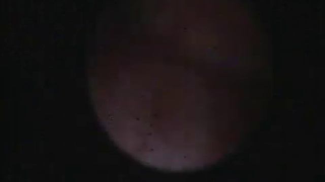 Короткий цервикальный канал после конизации шейки