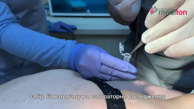 Радіохвильове видалення родимки. Кривий Ріг смотреть онлайн