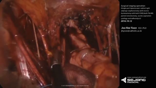 Single Port laparoscopic surgical staging operation using Lapsingle Plus(5/5) смотреть онлайн
