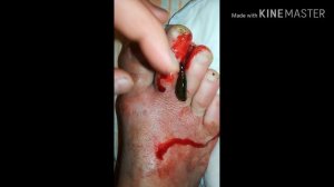 Исцеление пиявками. Пиявки спасли от ампутации.