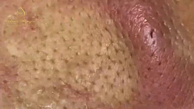 #асмр #acnetreatment #прыщи #угри #давкаугрей