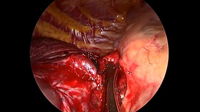 Non-intubated SVATS right upper lobectomy and lymph node dissection - part 1 смотреть онлайн