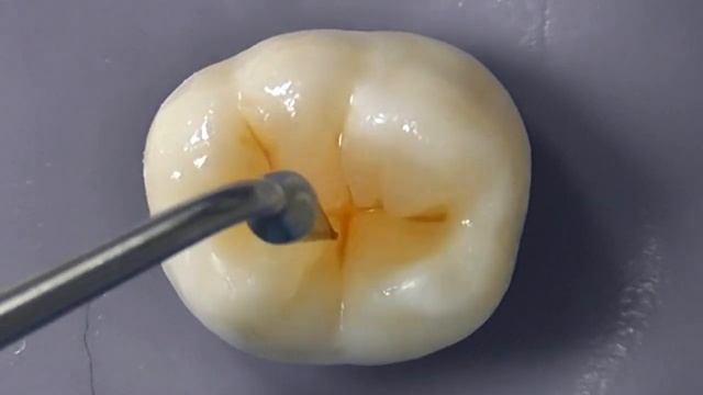 СЕКЦИОННАЯ МЕТОДИКА МОДЕЛИРОВАНИЯ ОККЛЮЗИОННОЙ ПОВЕРХНОСТИ смотреть онлайн