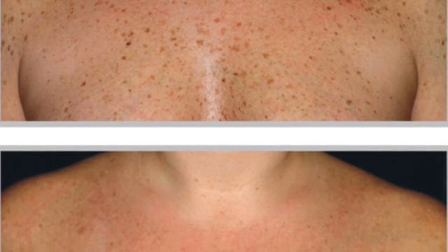Pro Age Medical & Aesthetics - Forever Young BBL - FotoFacial смотреть онлайн
