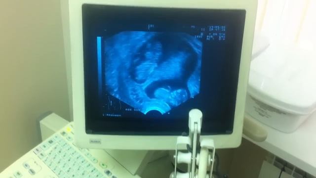 Узи двойни, 10-11 недель | Twins Ultrasound (10-11 weeks) смотреть онлайн