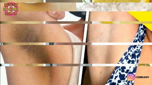Как БЫСТРО отбелить подмышки и локти///Эффективное средство!