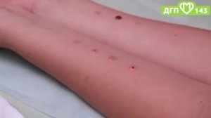 Аллергопробы