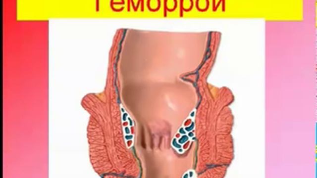 Как избавиться от варикозной болезни? Эндорфинотерапия. смотреть онлайн