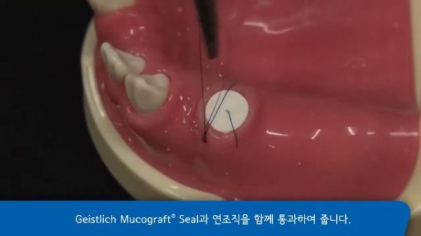 Пример использования Mucograft® Seal & Geistlich Bio Oss® Collagen / АПЕКС