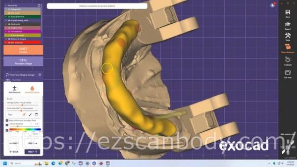 Exocad All on X Thimble bar design using EZ Scanbody