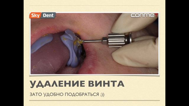 Коронка на имплант #13 смотреть онлайн