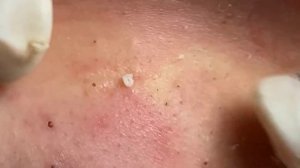 Удаление черных точек 2022 ep02