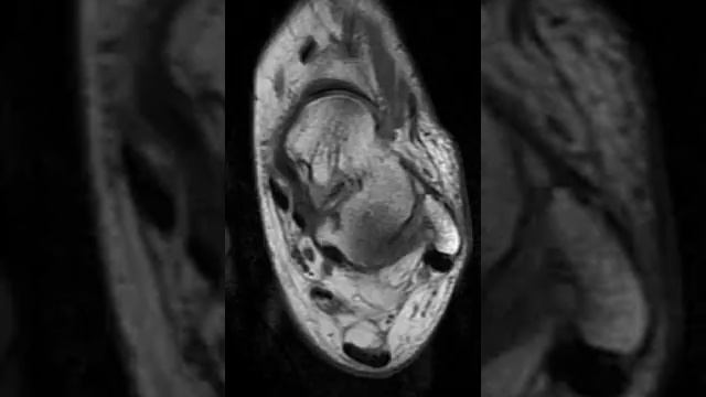 Ankle Flexor Digitorum Accessorius Longus musle смотреть онлайн