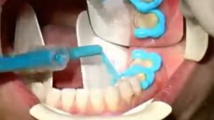 Препарирование + изготовление временной коронки - Protezist