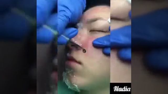 Чистка лица