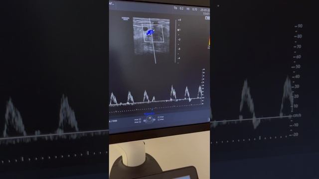 Нарушение ритма во время узи сосудов. Обследование сосудов. Флеболог Москва. Флеболог смотреть онлайн