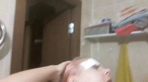 Удаление татуажа бровей ремувером у Виктории Томашивской. Первая неделя после процедуры.