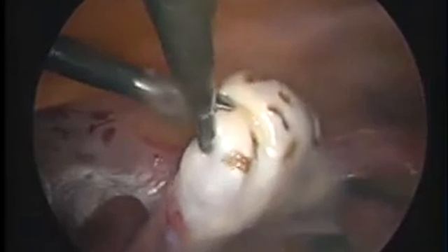 Лапароскопическая декортикация яичников при СПЯ смотреть онлайн