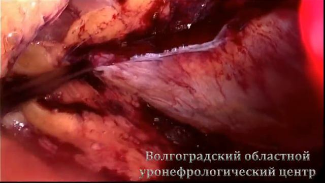резекция хвоста поджелудочной смотреть онлайн