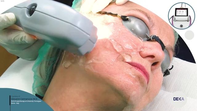DEKA Luxea - Intense Pulsed Light Lilac Photo Rejuvenation Treatment 01 смотреть онлайн