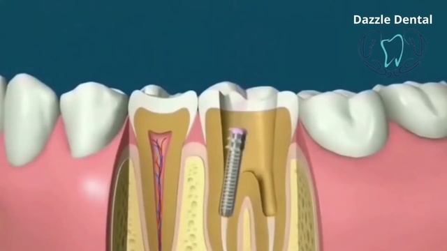 Amazing Smile Design of Lower Jaw | Dazzle Dental Care Bhubaneswar смотреть онлайн