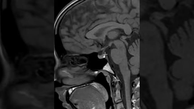 How to read an MRI of the pituitary gland | First Look MRI смотреть онлайн