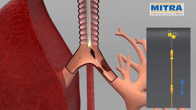 Tracheobronchial "Y" stent, MITRA OTTOMED ENDOSCOPY, Interventional Pulmonology смотреть онлайн