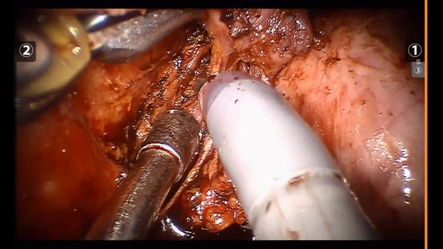 Robotic lymph node dissection after neoadjuvant CCRT смотреть онлайн